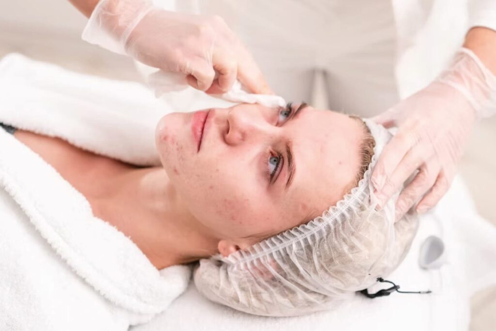 Acne Treatment in Gurgaon