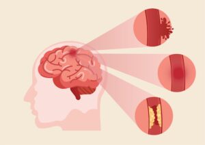 Brain Clot Symptoms