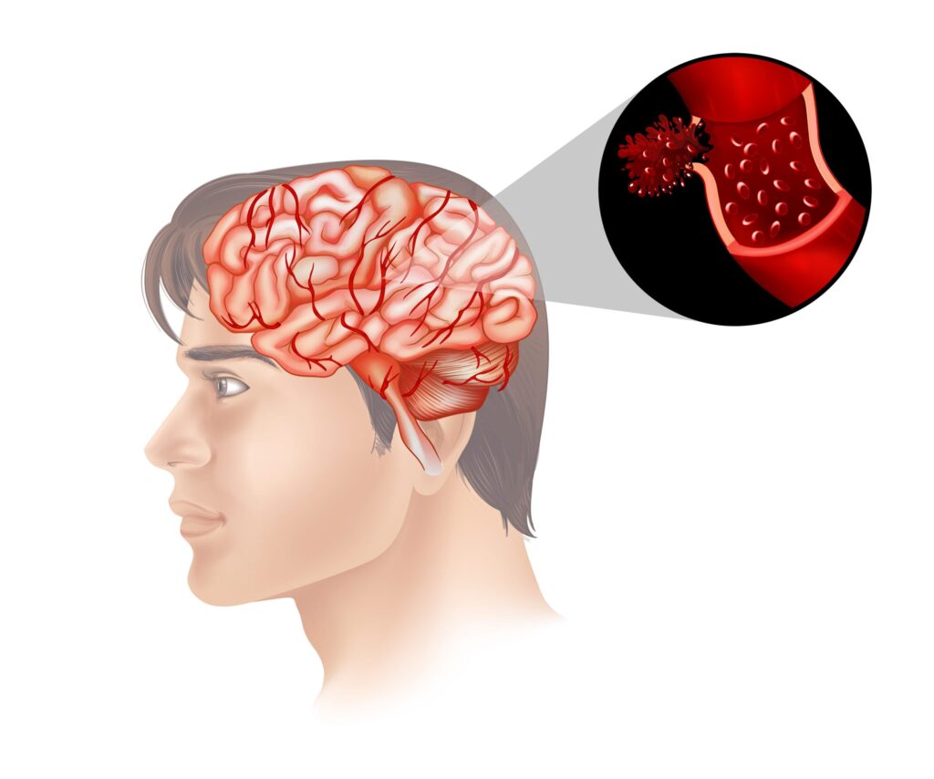 Brain Tumor Symptoms