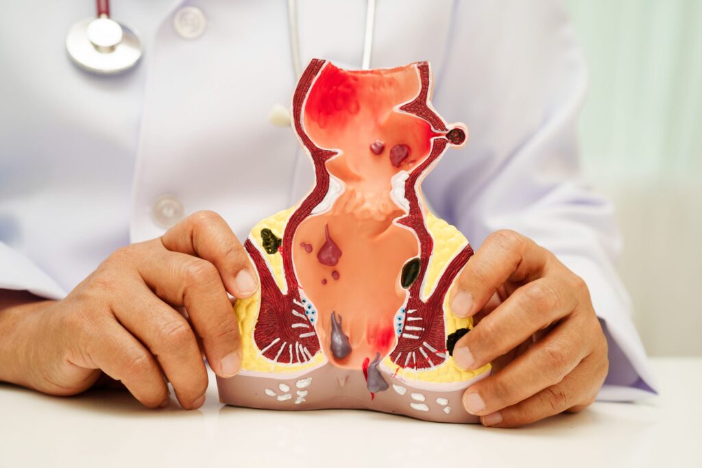 Best Piles Doctor in Gurgaon