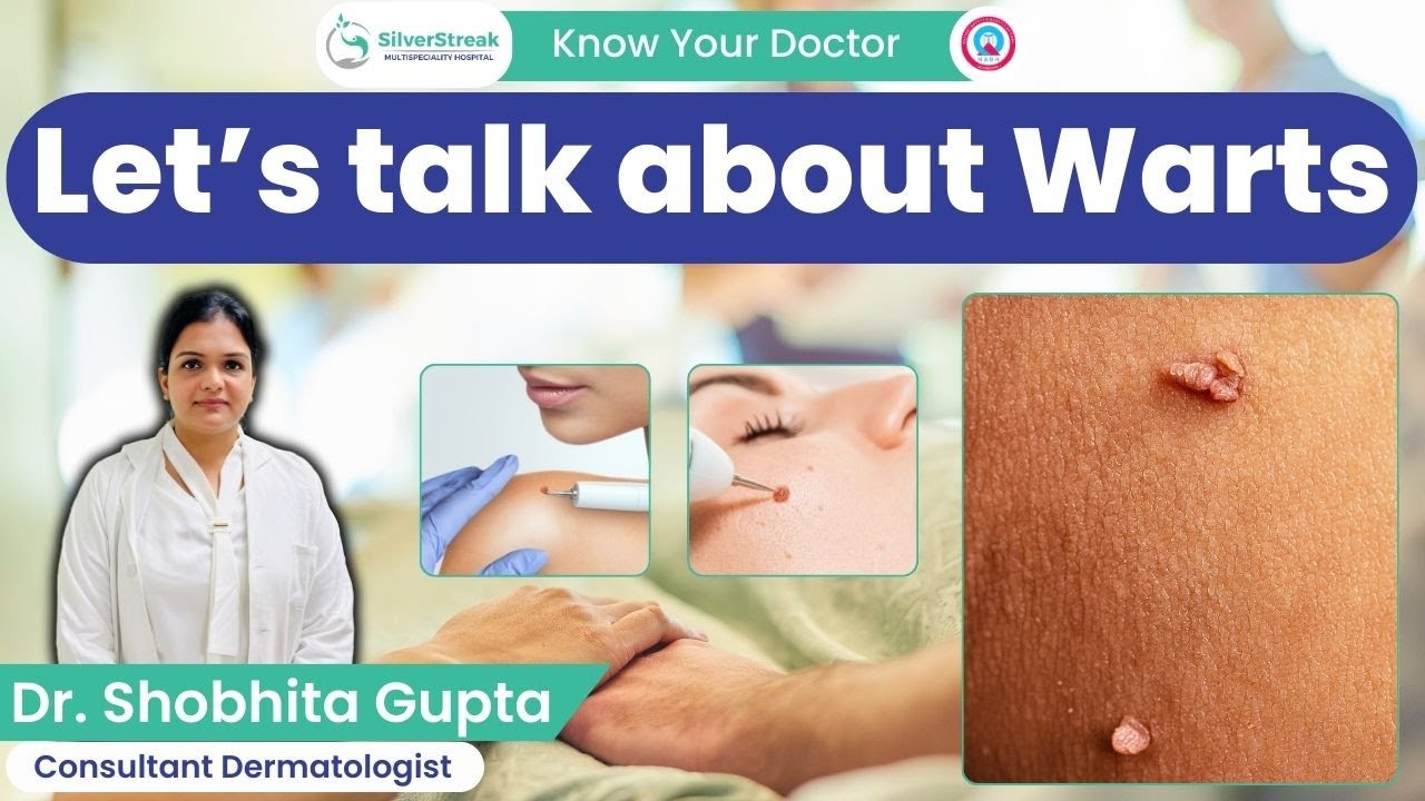 Let’s talk about Warts