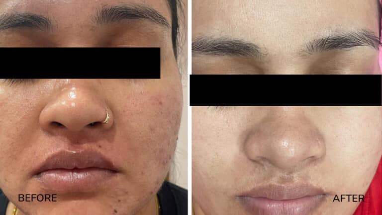 derma-3