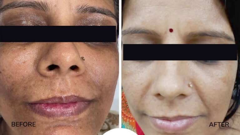 derma-5