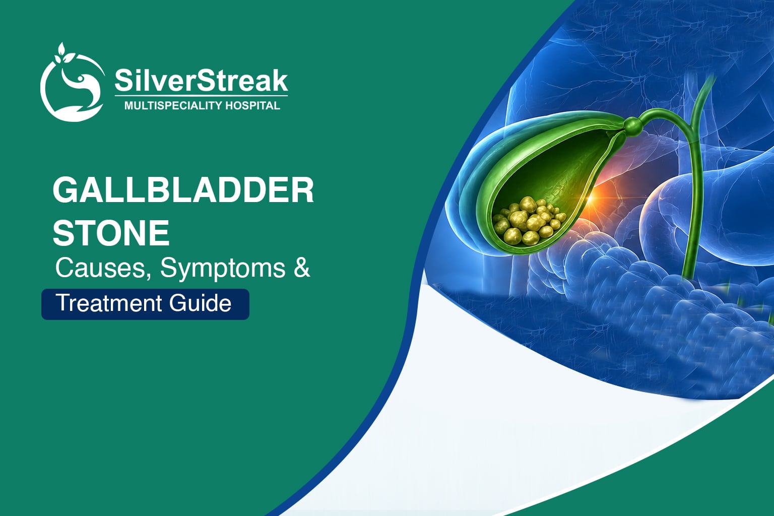 Gallbladder Stone — Causes, Symptoms & Treatment Guide