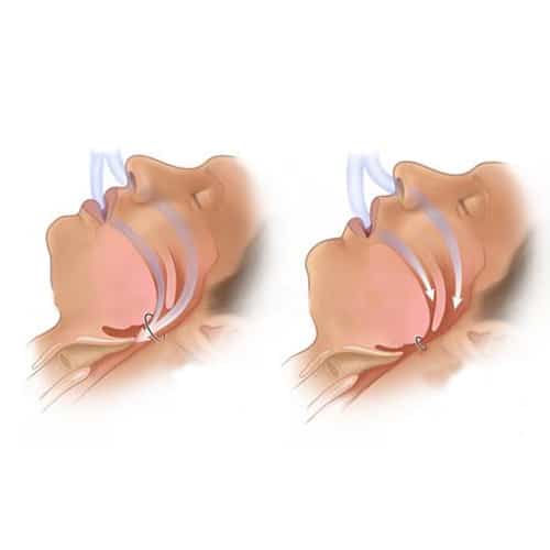 Snoring and sleep apnea hospital in india