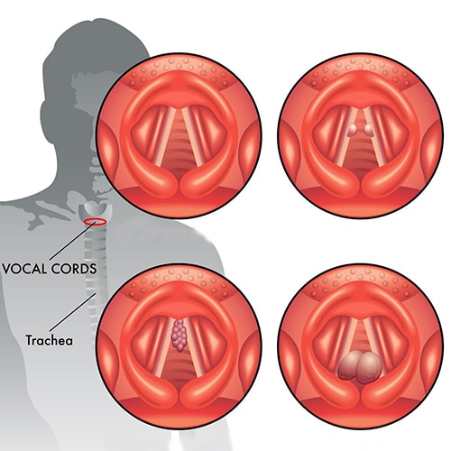 Voice box issues hospital in india