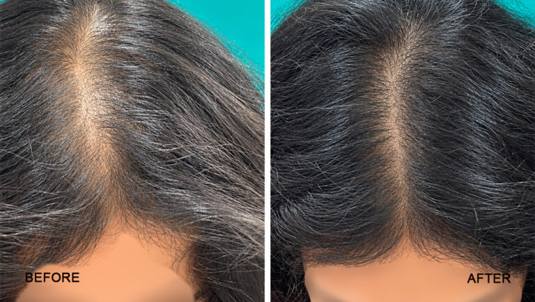 before after -1