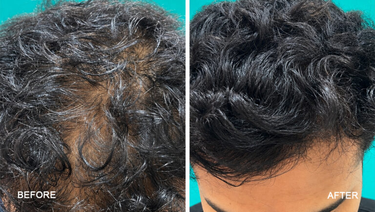 before after -3