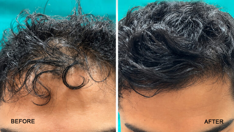 before after -4